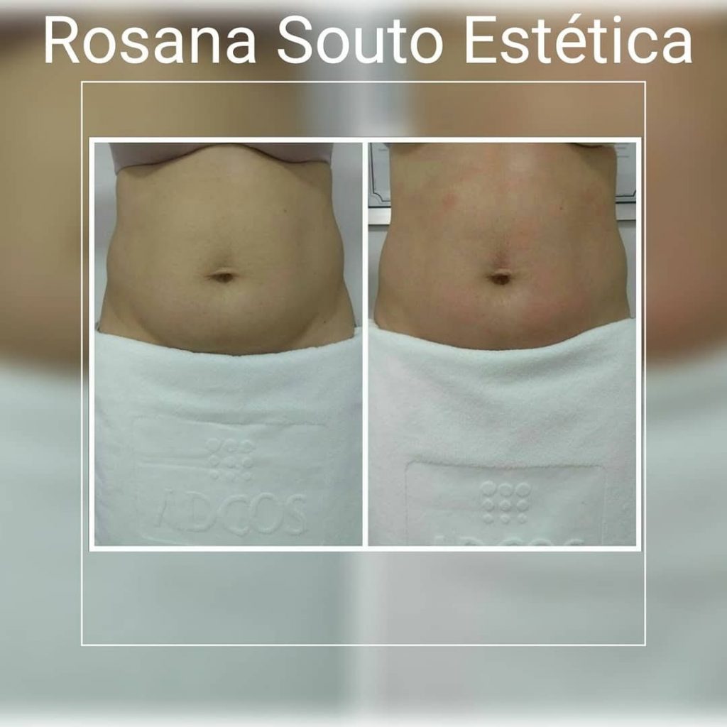 Ultrassom Cavitacional, A Lipo sem Corte - Rosana Souto Bauru