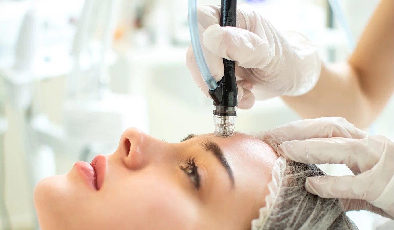 Peeling de cristal em Bauru na clínica Rosana Souto Estética